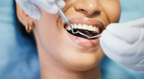 Best Knocked-Out Tooth (Avulsed Tooth) Treatment in Dalton Gardens, ID